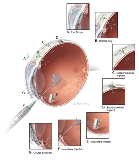 Principal methods of local drug delivery to the eye
