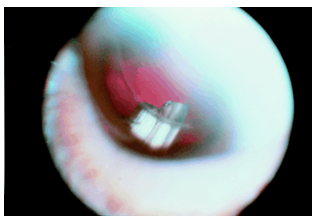 Corticosteroids effects on wound healing