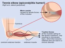 thesis on tennis elbow thesis on tennis elbow