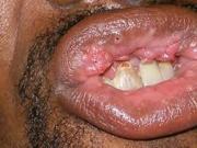 Genital Warts Photos - Dermatology Education