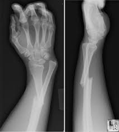 Osteogenesis imperfecta research paper