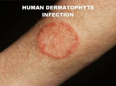 dermatophyte infections