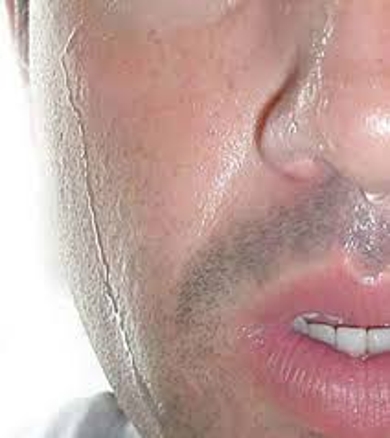 Facial Perspiration 78