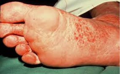 foot infections #10