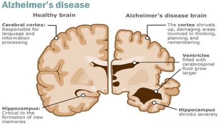 Assignment about alzheimer disease