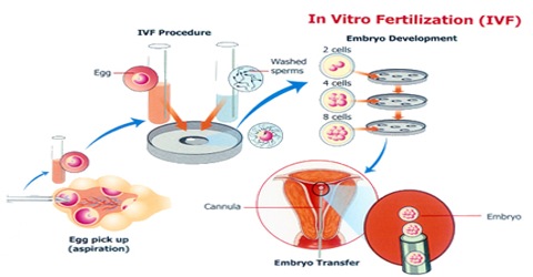 Using Ivf Vitro Fertilisation