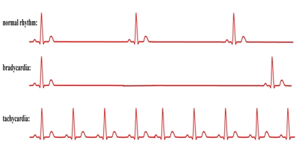 Arrhythmia 