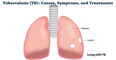 Essay/Term paper: Tuberculosis