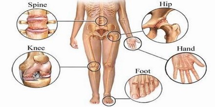 artrita și artroza tratamentului degetelor pentru articulația umărului cu osteochondroză