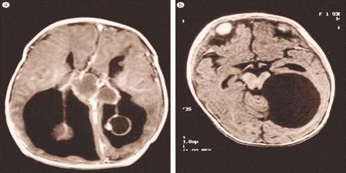 Aicardi Syndrome - Assignment Point