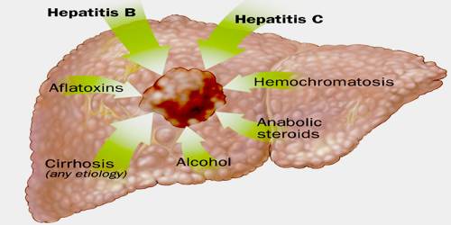 hepatic cancer etiology