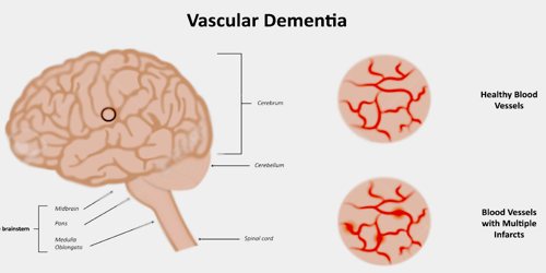 Vascular Dementia - Assignment Point