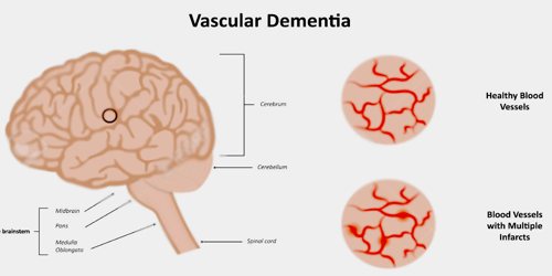 vascular dementia