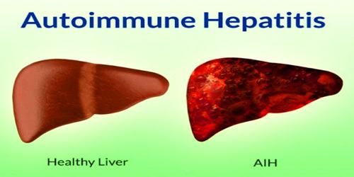 Autoimmune Hepatitis