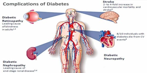 Diabetes Mellitus (Types, Causes, and Complications) - Assignment Point