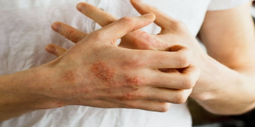 symptoms of latex mattress allergy