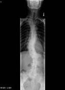 About Congenital Scoliosis