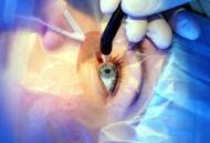 Refractive Eye Surgery