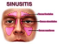 About Sinusitis