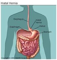 Hernia Symptoms
