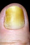 About Yellow Toenails