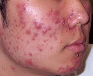 Information about Acne