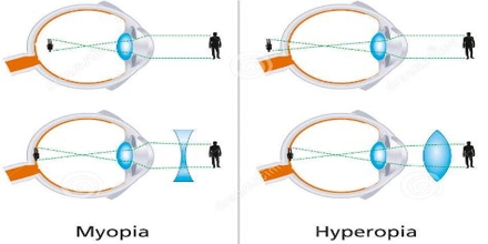 Human Eye: Hyperopia and Myopia