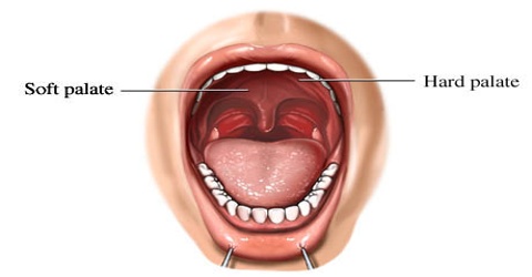 Palatal petechiae