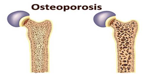 Term paper about osteoporosis