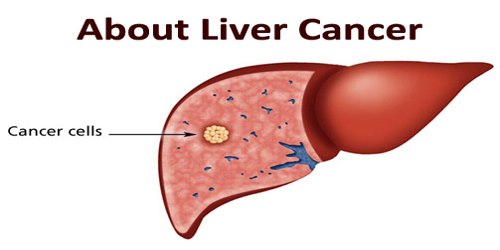 hepatic cancer what is it