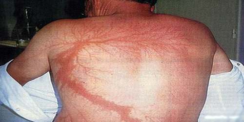 Lightning Injuries - Assignment Point