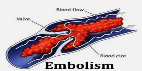 Embolism