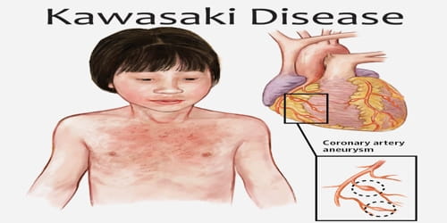 Gå op Alternativt forslag Snuble Kawasaki Disease - Assignment Point