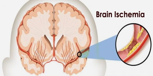 Brain Ischemia Assignment Point