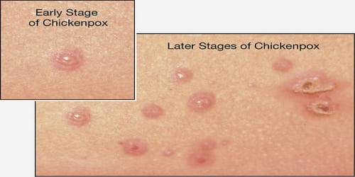 chickenpox (causes, symptom, and complications)