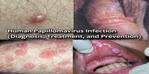 human papillomavirus infection untreated)