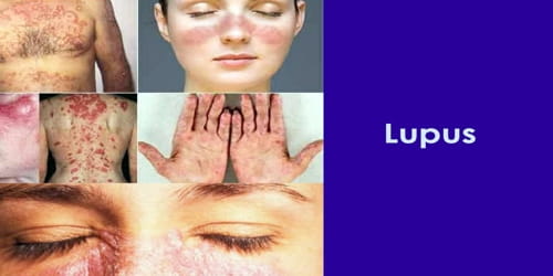Meaning lupus Answered: It’s