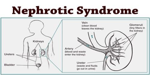 نتيجة بحث الصور عن ‪Nephrotic Syndrome‬‏