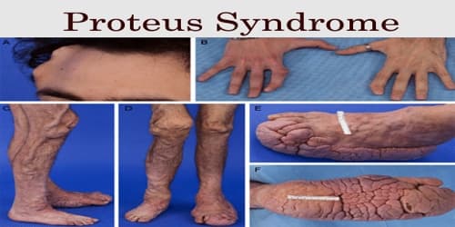 Proteus syndrome