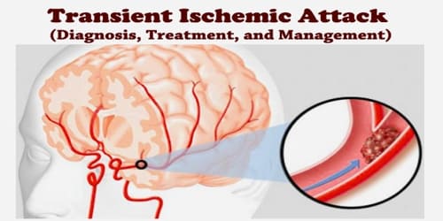 Transient Ischemic Attack Diagnosis Treatment And Management Assignment Point