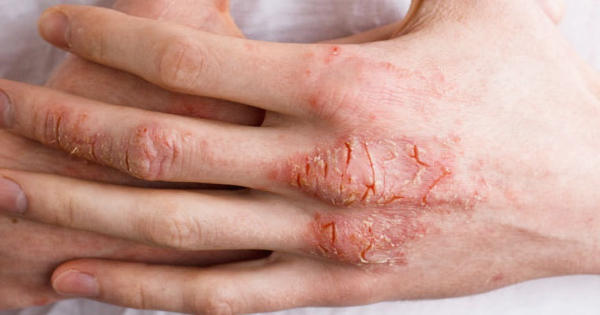 Researchers identified a key enzyme that may prevent eczema